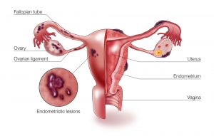 Endometriosis-3